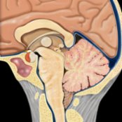 Graphic shows IH with distended dural sinuses  and enlarged pituitary  and herniated tonsils . Central brain descent causes midbrain slumping, inferiorly displaced pons, closed pons-midbrain angle , and splenium depressing ICV/vein of Galen junction .