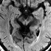 Axial FLAIR MR in the same patient shows striking atrophy of the midbrain tectum (colliculi)  and concave margins of the midbrain tegmentum .