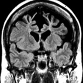 Coronal T1WI MR in a patient with FTD shows prominent atrophy of both frontal lobes, which appears more pronounced on the left side.
