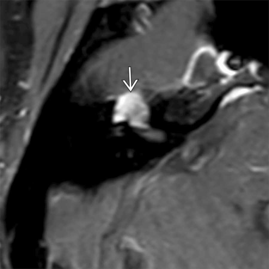 Axial T1 C+ FS MR shows enhancement of a large schwannoma expanding the geniculate fossa . The geniculate ganglion is the most common area involved. Correlating with smooth, bony expansile changes on CT is helpful to confirm diagnosis.