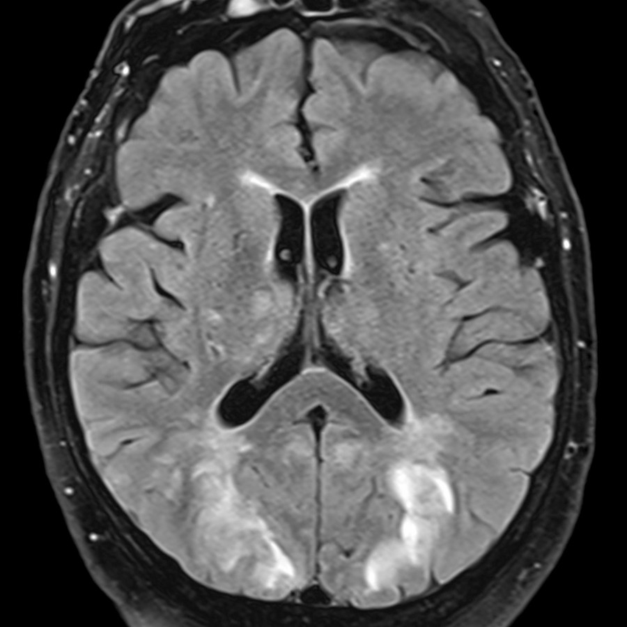 Axial FLAIR MR shows bilateral T2 hyperintensity in the occipital lobe cortex and subcortical white matter. In this patient with hypertension and renal failure, PRES was diagnosed. The DWI images were negative. Imaging of PRES often completely resolves when hypertension is controlled.