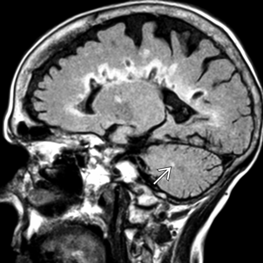 Sagittal FLAIR MR shows perpendicular callosal/pericallosal MS plaques with hyperintense rims & hypointense centers (with corresponding hypointensities also demonstrated on T1 as "black holes," not shown). Note an additional posterior fossa lesion .