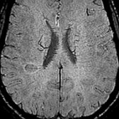 Axial SWI demonstrates characteristic perivenular location of a demyelinating plaque  with the medullary vein  coursing through it.
