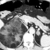 Axial CECT shows a large, heterogeneous fatty myelolipoma in the right adrenal gland and an adenoma in the left adrenal gland.