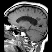 Sagittal T1WI MR shows multiple hypointense lesions ("black holes") in the periventricular WM   related to axonal destruction. Note the associated moderate ventricular and sulcal enlargement. T1 "back holes" are correlated with greater tissue damage and ↑ axonal destruction on histopathology.