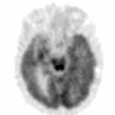 Axial F-18 FDG PET in a patient with advanced LBD shows decreased activity throughout the cortex, including the occipital lobe .