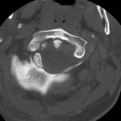Axial bone CT shows small, bony density without cortical margins adjacent to the right condyle, consistent with a nondisplaced right occipital condyle avulsion fracture .