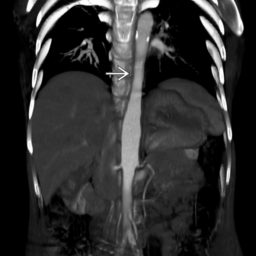 Coronal CECT shows tapered narrowing of the mid-descending thoracic aorta  in a patient with Takayasu arteritis.
