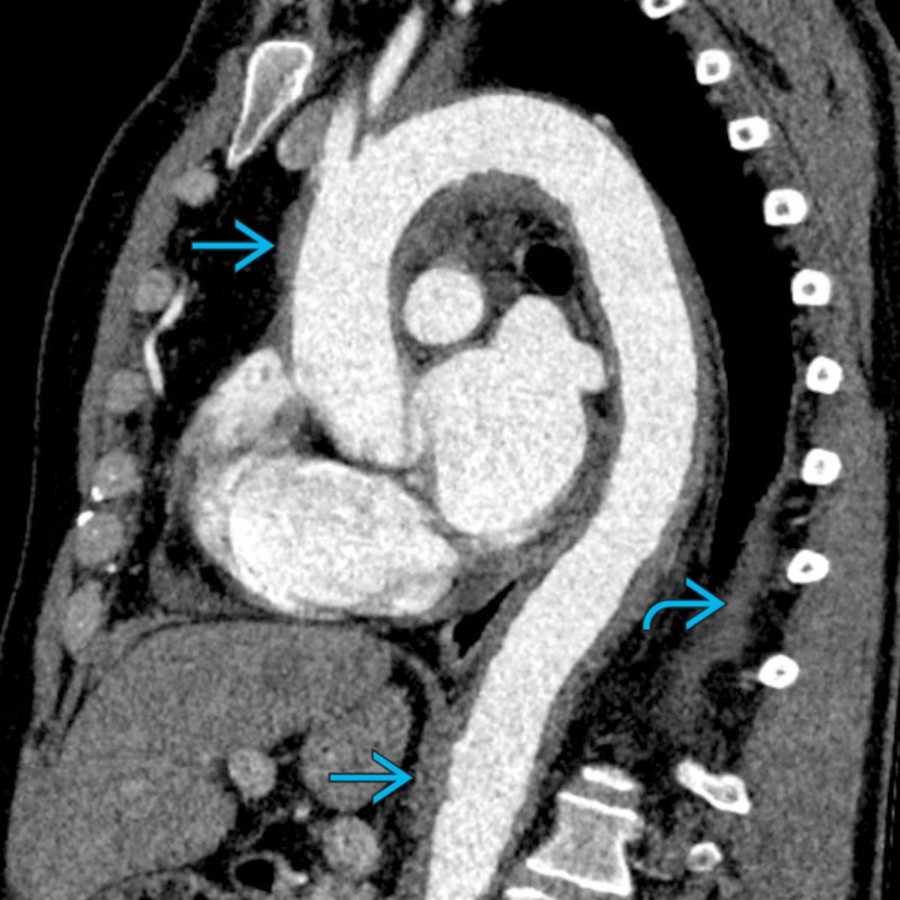 Sagittal oblique CTA in the same patient shows long-segment, continuous circumferential thickening of the entire thoracic and superior abdominal aorta . The pleura  is also thickened. There is no aneurysm or stenosis. ECD can mimic IMH on imaging.