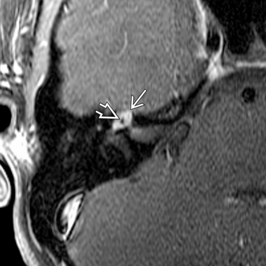 Axial T1 C+ MR with fat saturation in the same patient reveals FNVM  enhancing in the geniculate ganglion. The punctate ossific area is seen as an intralesional low-signal focus .