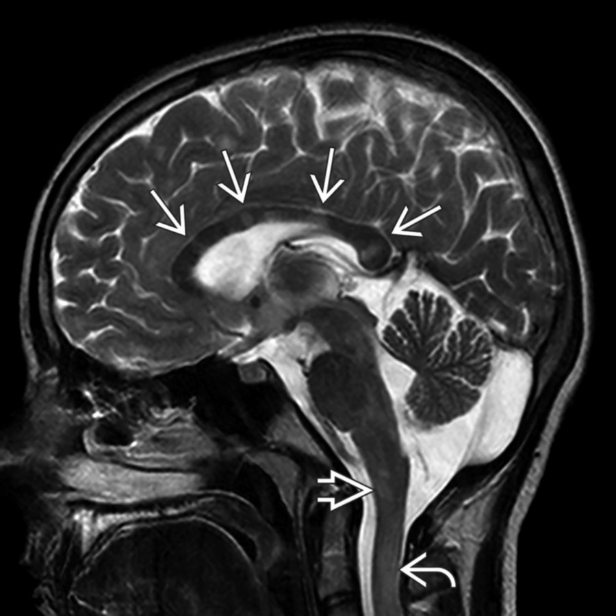 Sagittal T2 MR in a teenager presenting with acute ataxia demonstrates numerous hyperintense corpus callosum lesions  extending to the callosal-septal interface as well as brainstem, cervicomedullary , and cord lesions .