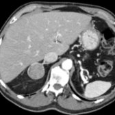 Axial CECT in the same patient shows heterogeneous enhancement of the right adrenal mass  (75 HU), indeterminate on single-phase CT.