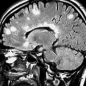 Sagittal FLAIR MR shows MS plaques with typical perpendicular orientation at the callososeptal interface along penetrating venules ("Dawson fingers"), as well as involving subcortical WM.