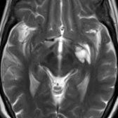 Axial T2 MR shows a cluster of CSF-like cysts in the inferior left basal ganglia , a common location for enlarged perivascular spaces. They are often seen at the level of the anterior commissure.