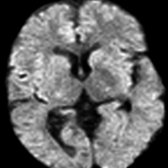 Axial DWI MR shows small foci of hyperintensity in the posterior limbs of bilateral internal capsules  in this ALS patient.