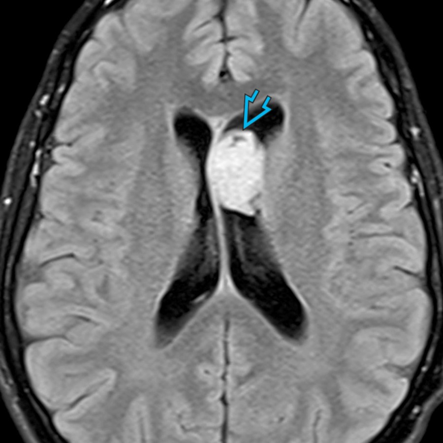 Axial FLAIR MR shows a hyperintense lateral ventricle mass  at the level of the septum pellucidum.  Subependymomas in the lateral ventricle are typically attached to the septum pellucidum or lateral wall.