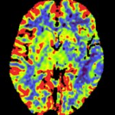 Whole-brain CT perfusion study was obtained as part of an emergency stroke evaluation in a patient with acute onset of right-sided weakness. CBF shows ↓ blood flow  (blue area) in the left MCA distribution.