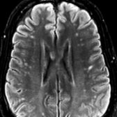 Axial FLAIR MR reveals multiple asymmetric, primarily punctate, hyperintense lesions of acute disseminated encephalomyelitis.