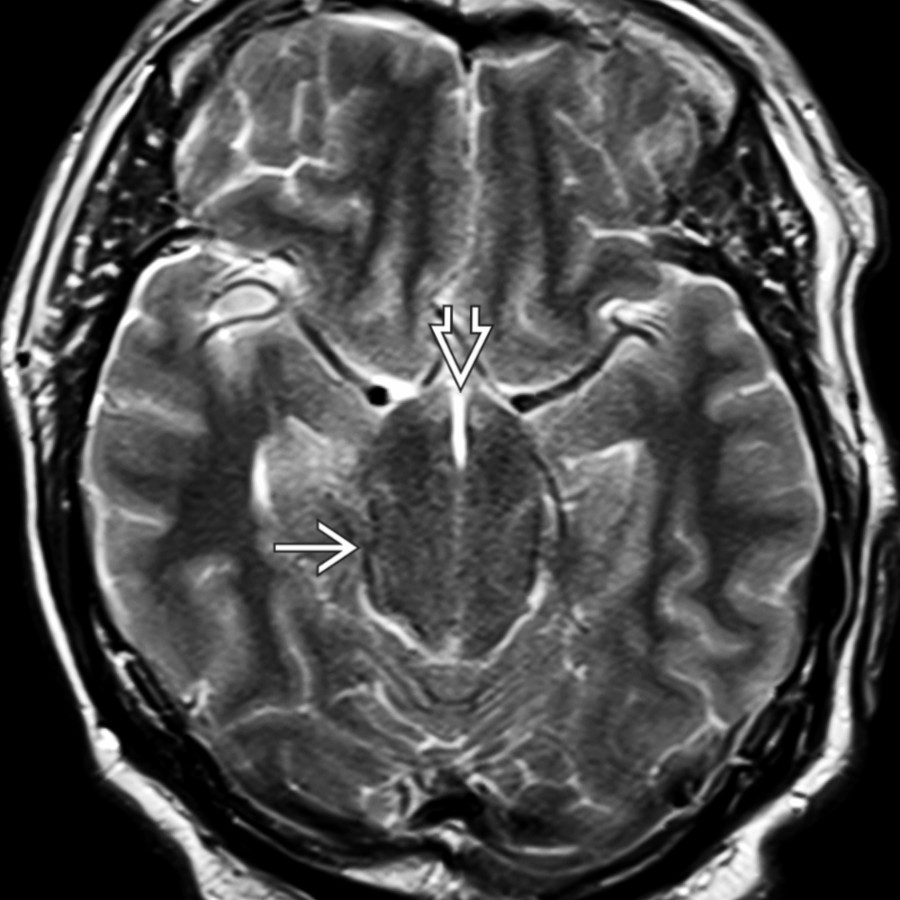Axial T2WI MR in the same patient shows the inferiorly displaced hypothalamus and 3rd ventricle obliterating the suprasellar cistern . The midbrain  appears "fat" and elongated.