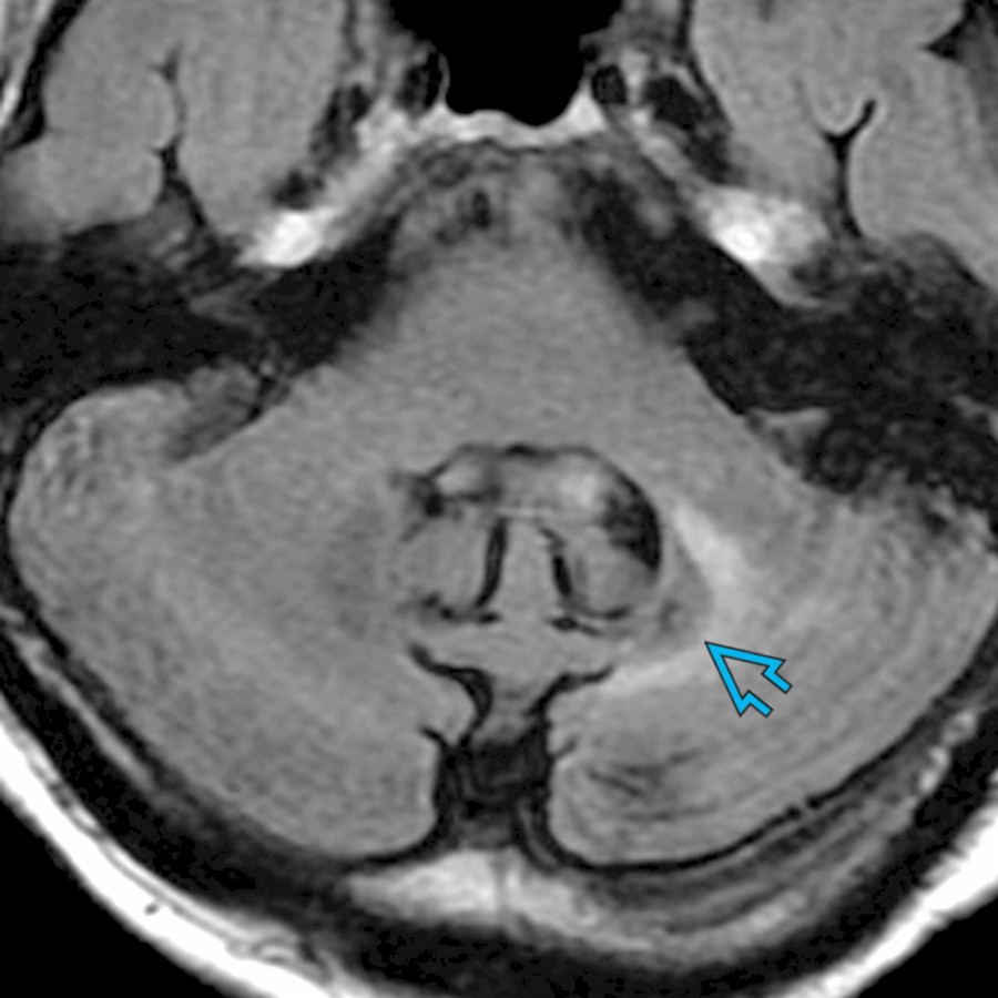 Axial FLAIR MR of a 58-year-old woman presenting with palatal myoclonus and a history of treated CNS lymphoma shows volume loss and hyperintense signal in left dentate nucleus (DN)  due to encephalomalacia (DN is a component of GMT).