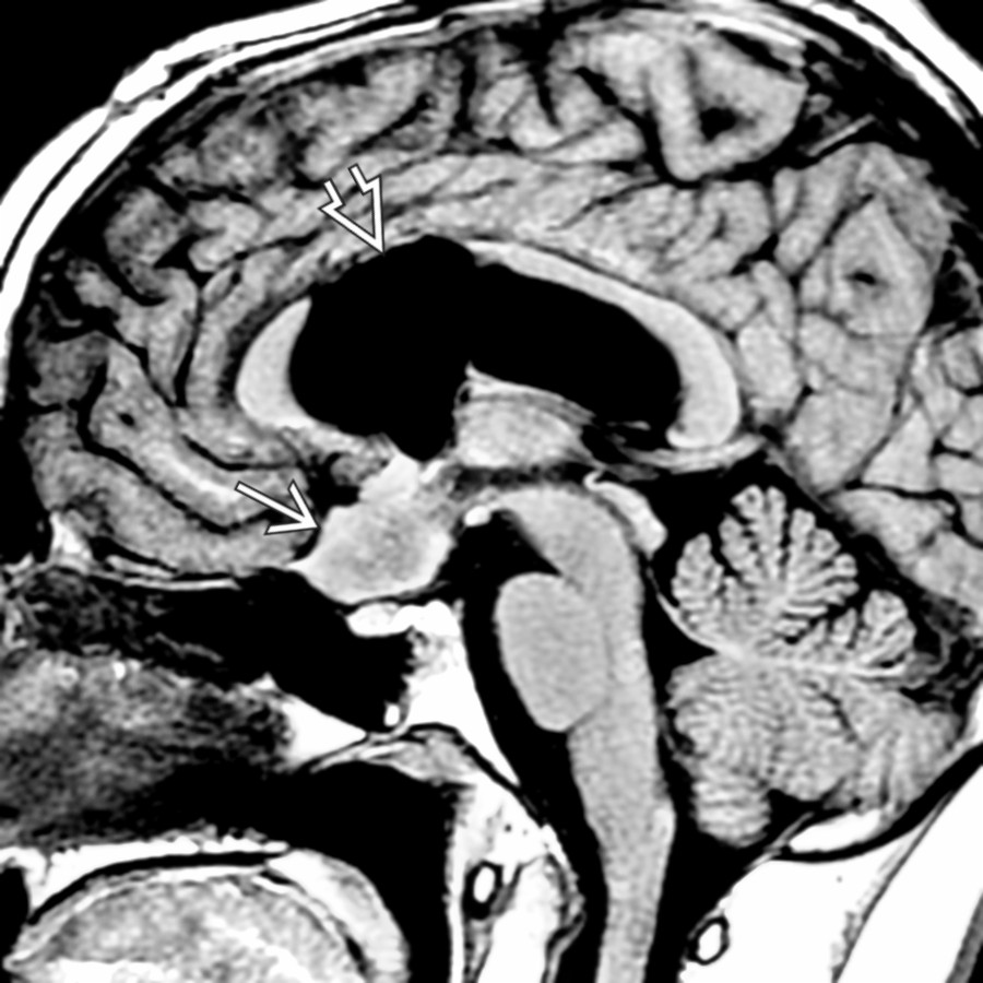 Midline sagittal T1 MR shows a focal defect at the junction of the genu & body of the corpus callosum , which had been the site of a prior surgical approach to this child's suprasellar tumor .