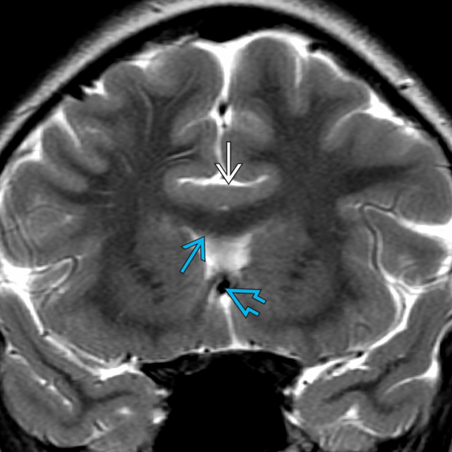Coronal T2 MR in the same patient with syntelencephaly shows abnormal GM   crossing the midline along the CC WM . Also note the azygous internal carotid artery (ICA)  .