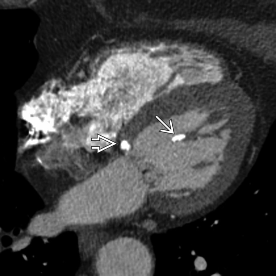 Four-chamber CECT shows both papillary muscle  and mitral valve annular  calcification. Papillary muscle calcification is commonly seen in dialysis patients.