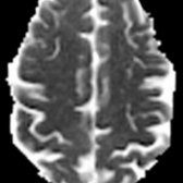 Axial ADC map in the same ALS patient appears normal.