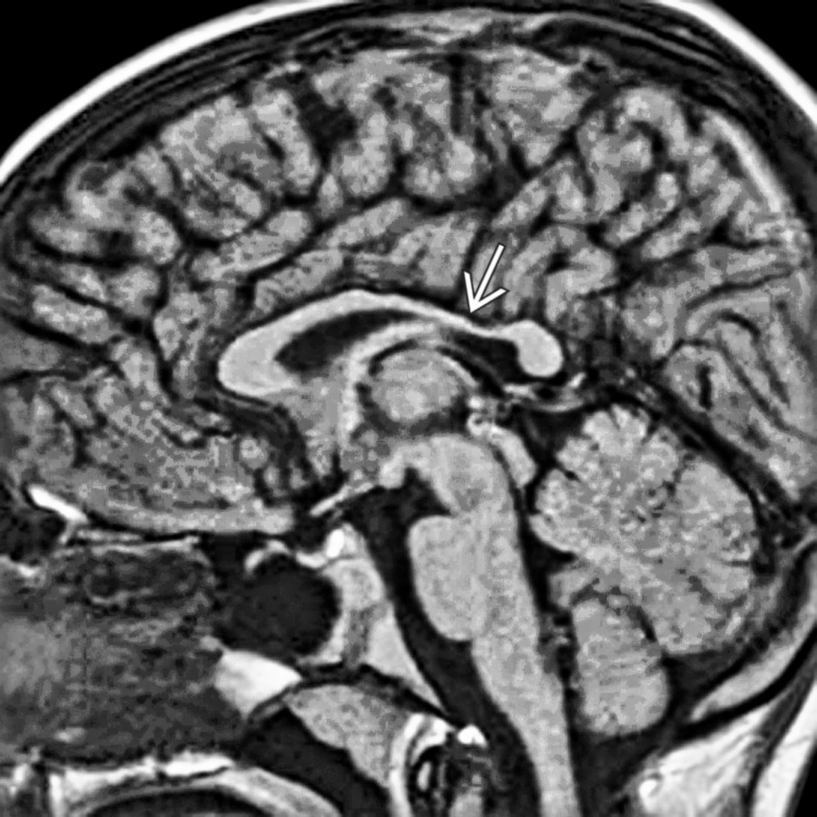 Midline sagittal T1 MR shows diffuse thinning of the posterior corpus callosum , greater than typically seen. The thinning of the corpus callosum is secondary to loss of commissural fibers, damaged by periventricular leukomalacia.