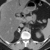 Axial CECT in a 53-year-old man shows an incidental myelolipoma  containing calcifications .