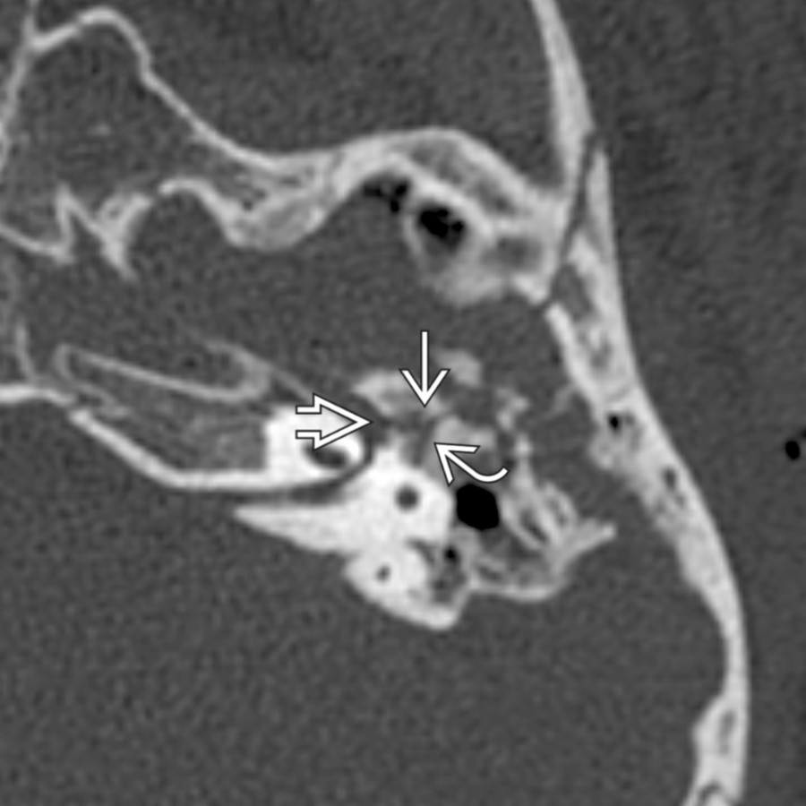 Axial NECT shows a complex T-bone fracture with transverse component  violating the anterior genu  and anterior tympanic  segments of the CNVII canal.