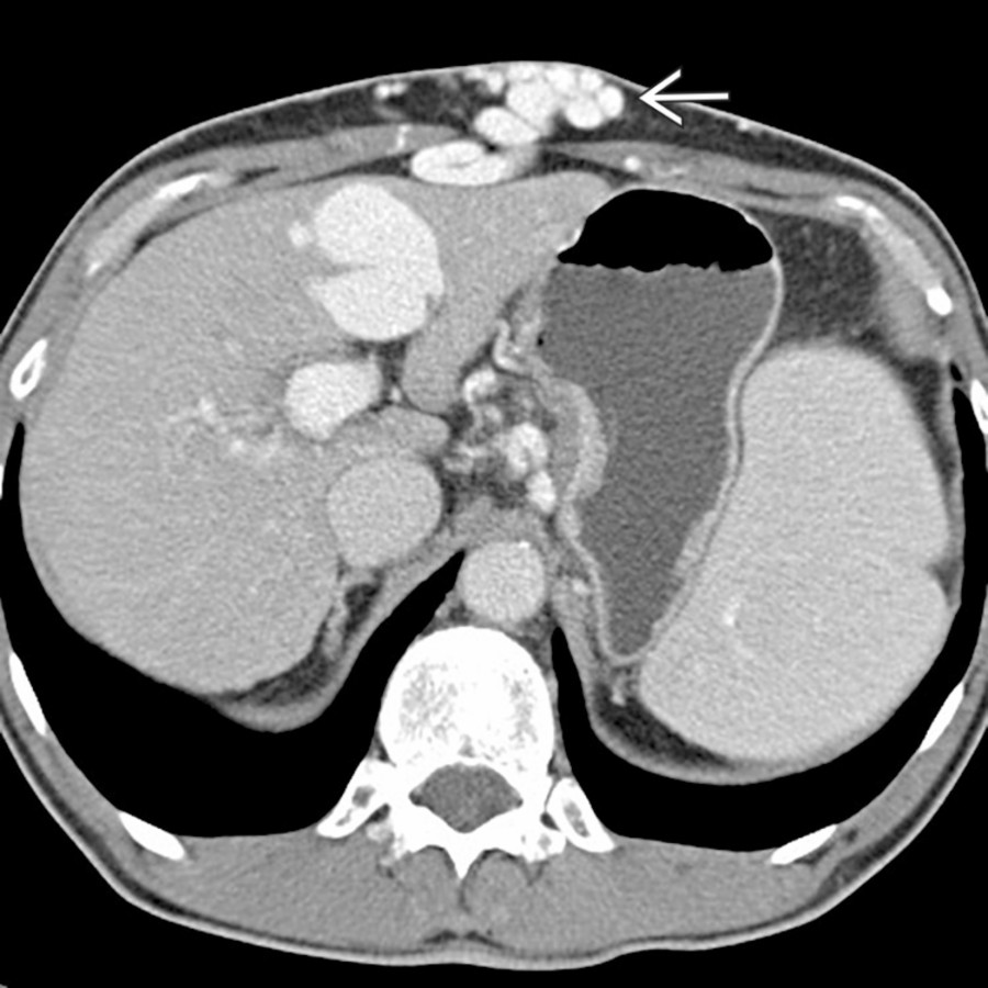 Axial CECT in a patient with cirrhosis and portal hypertension shows subcutaneous varices    overlying the anterior abdominal wall, representing a caput medusae.