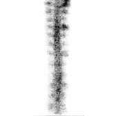 Posterior radionuclide cisternography shows partial epidural injection of In-111 DTPA. Note the classic Christmas tree appearance  of radiotracer in the epidural space surrounding the thecal sac and spinal nerve roots. This may result in indeterminate imaging due to lack of tracer in the CSF space.