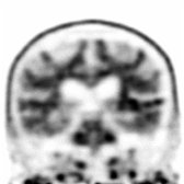 Coronal F-18 florbetapir PET shows areas of uptake that resemble only white matter uptake  at 1st glance without activity reaching the gray matter .