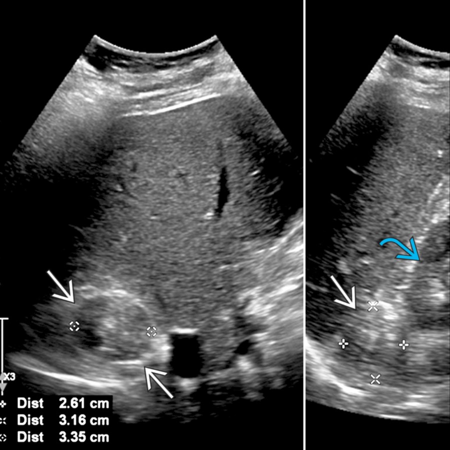 Transverse (left) and longitudinal (right) transabdominal ultrasound show a well-demarcated, heterogenous, solid right adrenal mass  hyperechoic to the renal cortex , proven to be a pheochromocytoma.