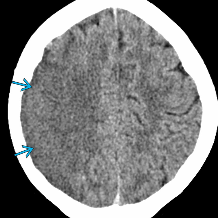 Axial NECT in a 15-year-old girl with dilated cardiomyopathy shows a large area of low attenuation in the right middle cerebral artery (MCA) territory . Note the sulcal effacement & loss of the gray matter-white matter differentiation.