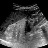 Sagittal US in a 44-year-old woman with abdominal pain shows a large, echogenic suprarenal mass  that displaces the kidney . CT was recommended given the size of the lesion.