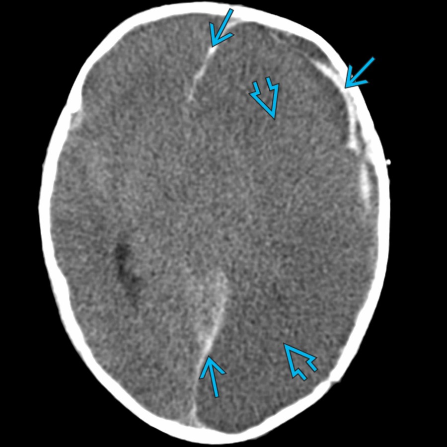 Axial NECT in a 2-month-old with AHT shows subdural hemorrhage  over the left frontal lobe & along the falx. Note the extensive areas of ↓ attenuation  & loss of gray matter-white matter differentiation with significant left-to-right midline shift.