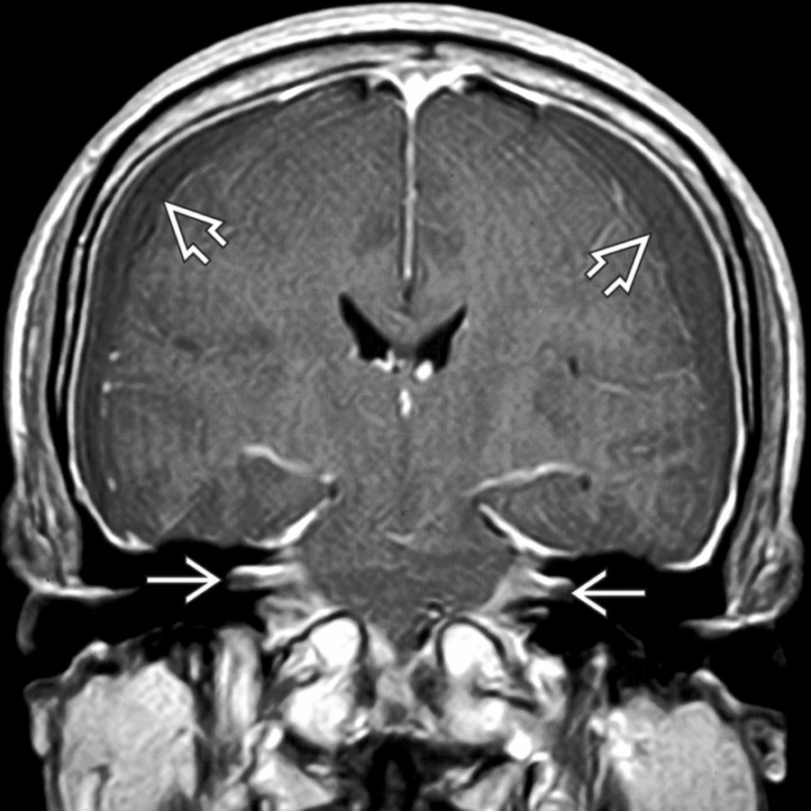 Coronal T1WI C+ MR in the same patient shows subdural fluid  with diffuse dural thickening extending into both internal auditory canals . The lateral ventricles are pulled toward the midline.