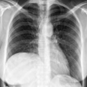 PA radiograph of the chest in a young asymptomatic patient with chronic traumatic aortic injury (CTAI) and right diaphragmatic hernia shows curvilinear calcification lining the caudad part of the aortic arch . There is elevation of the right hemidiaphragm form chronic undiagnosed right diaphragmatic hernia . Note remote rib fractures .