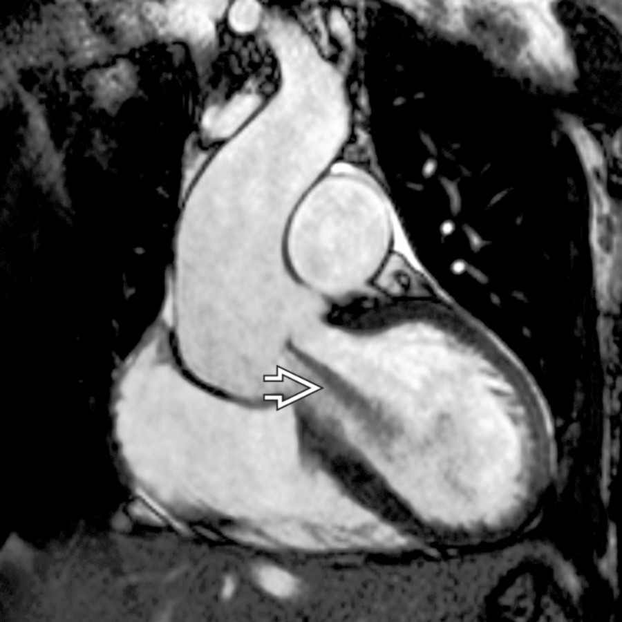 Coronal cine MR shows a turbulent jet originating at the aortic valve, directed toward the LV chamber .