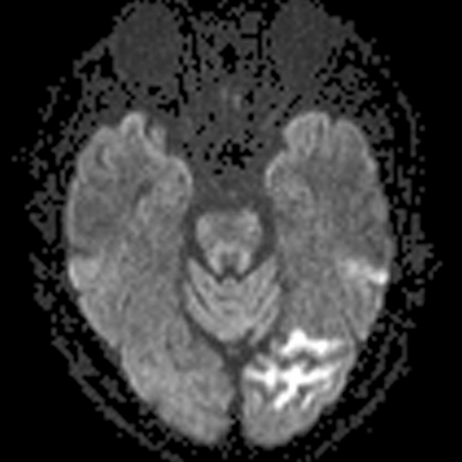 Axial DWI MR in the same patient shows hyperintensity within the left PCA distribution. The hyperintensity represents a combination of true diffusion restriction and T2 shine-through.