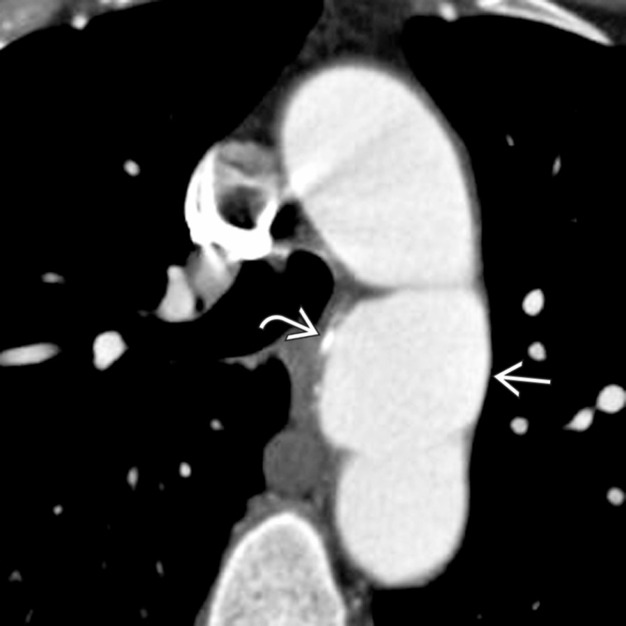 Axial chest CTA in the same patient demonstrates saccular isthmic aortic dilatation  with some mural calcifications  in continuity with the aortic lumen.