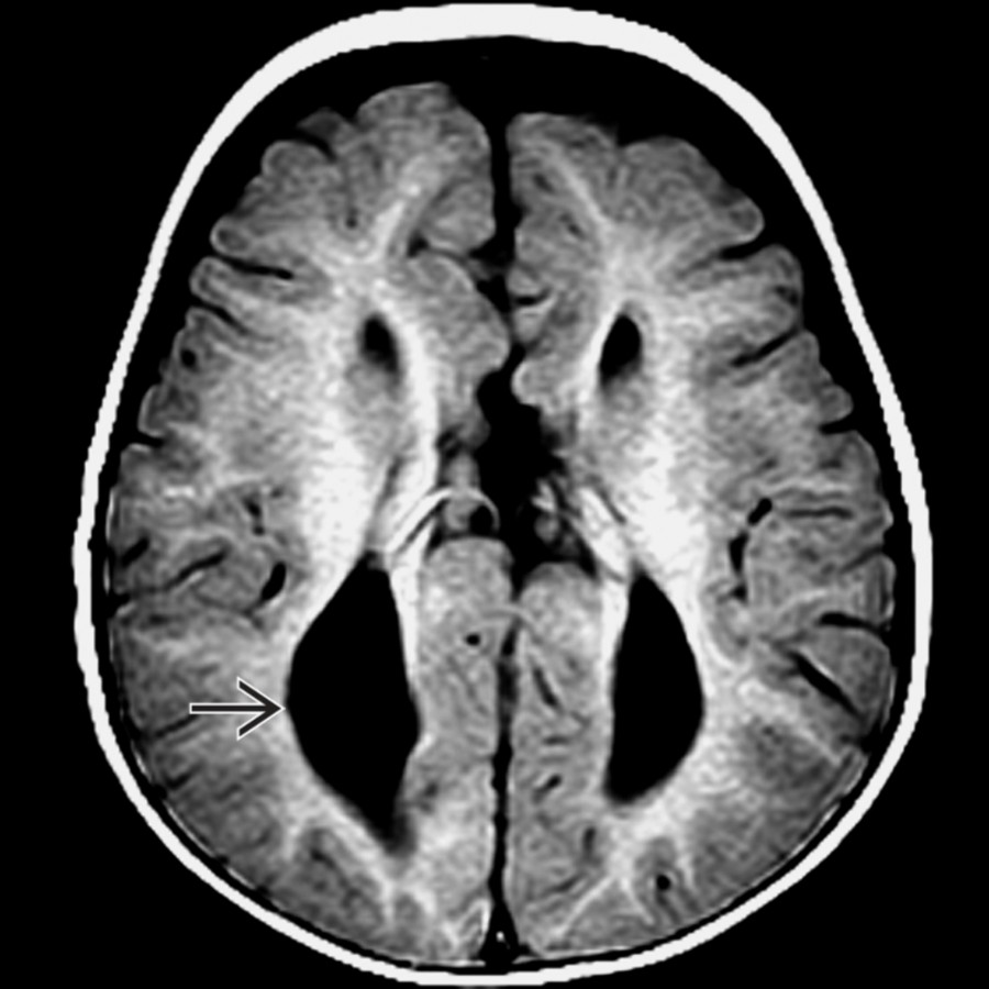 Axial T1 MR in a patient with callosal agenesis shows parallel lateral ventricles with colpocephaly , resulting in a typical tear-drop shape.