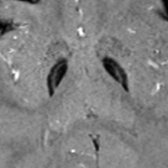 Axial SWI MR in an 8-year-old boy with MPAN shows excess iron in GP with characteristic hyperintensity in medial medullary lamina .