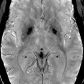 Axial SWI in a 67-year-old woman shows striking hypointensity in the globi pallidi  with less prominent hypointensity in the putamina  due to iron deposition.
