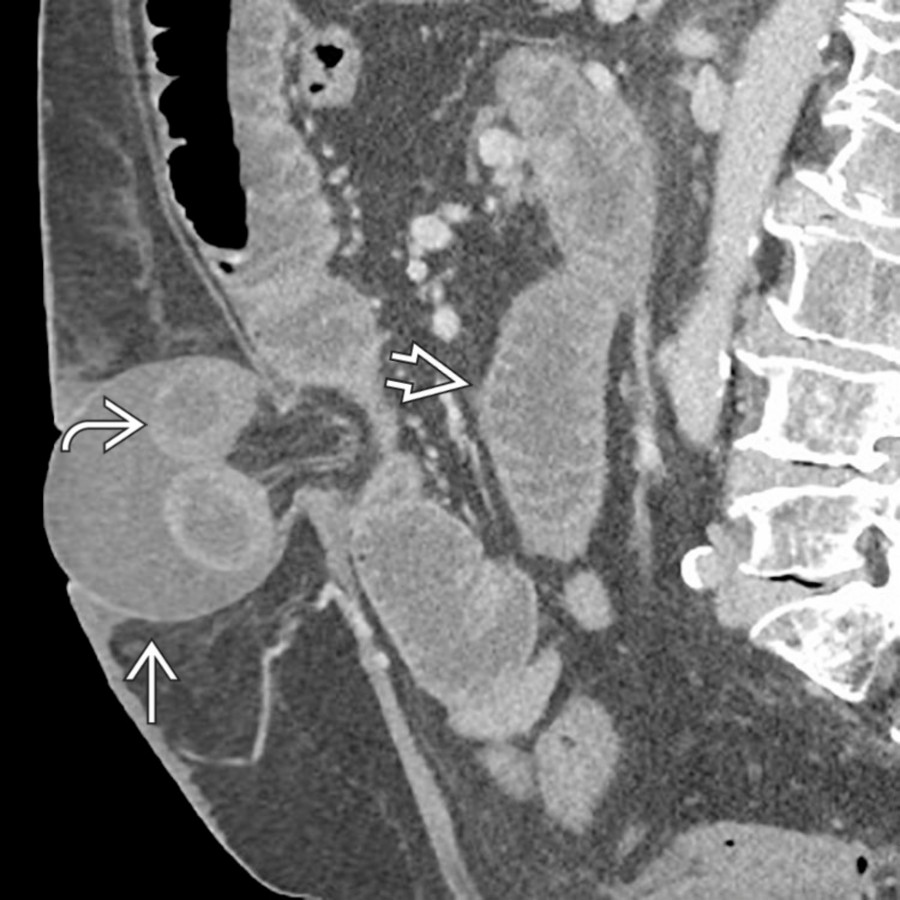 Sagittal CECT demonstrates an umbilical hernia  containing a loop of bowel  with surrounding ascites. Note the dilated small bowel  upstream from the hernia, compatible with bowel obstruction. The strangulated bowel was found to be ischemic at surgery.