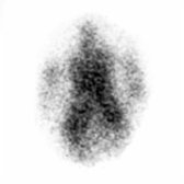 Planar vertex view (top of head with shielding around shoulders) in the same patient shows clear activity in the lateral ventricles , confirming diagnosis of NPH.