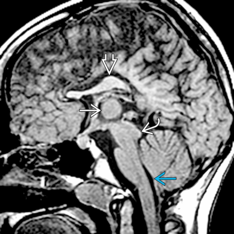 Midline sagittal T1 MR shows an abnormal corpus callosum with an absent rostrum, small deformed genu, thick body , & absent splenium in this child with a Chiari 2 malformation due to a myelomeningocele. Note the prominent massa intermedia , inferiorly beaked tectum , & caudally displaced elongated 4th ventricle with flattening of the fastigium .