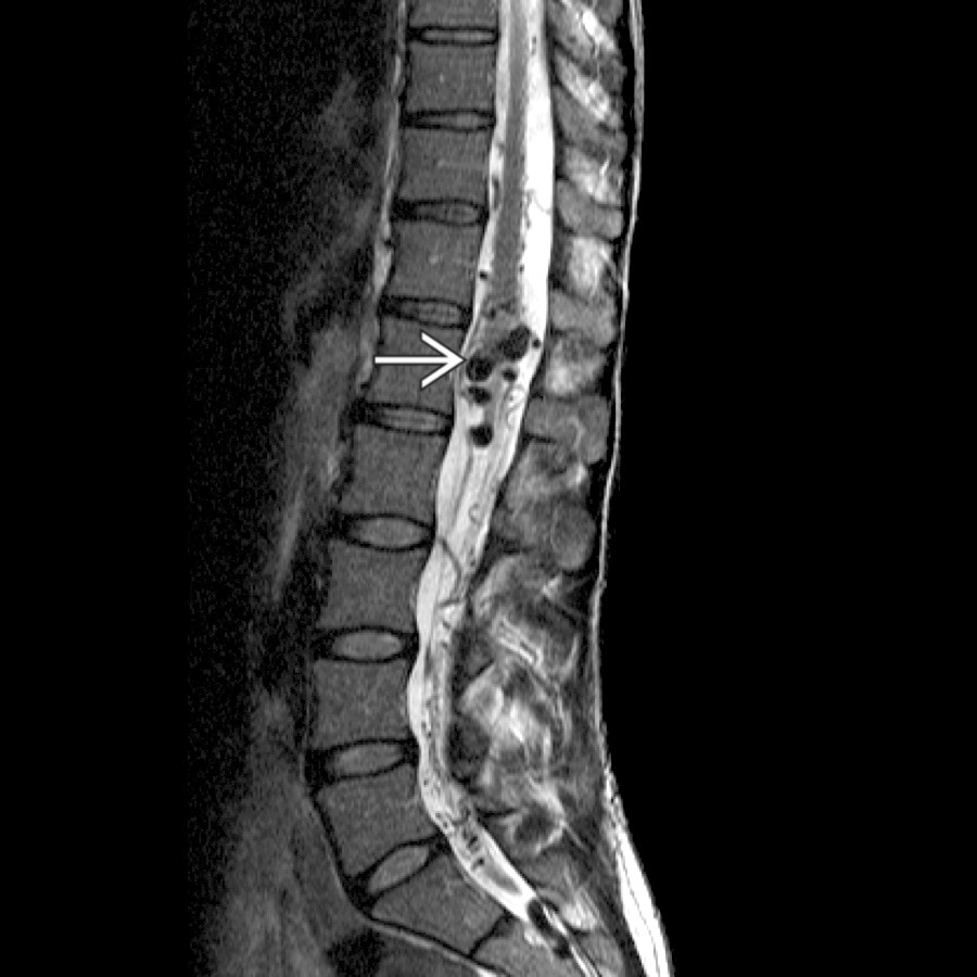 Sagittal T2 MR shows multiple prominent round flow voids  from nidal aneurysms and venous varices in this patient with a large conus-type arteriovenous malformation (AVM).